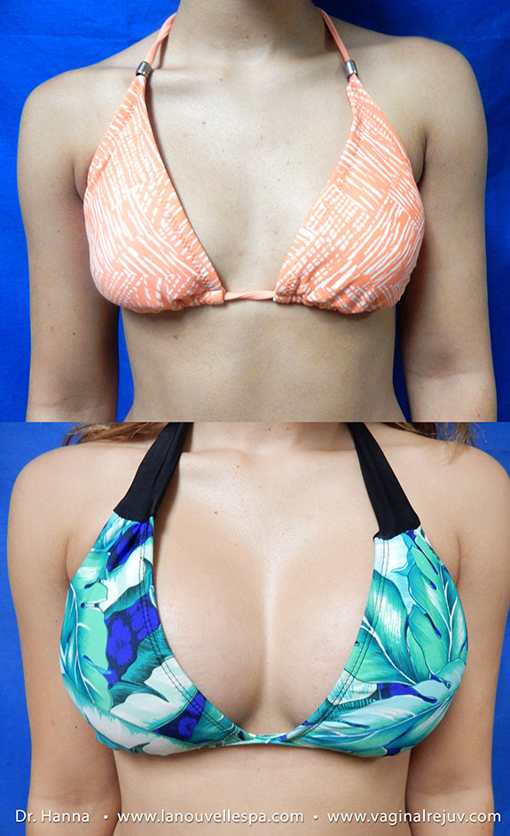 breast augmentation with silicone implants by doctor antoine hanna ventura, oxnard, los angeles