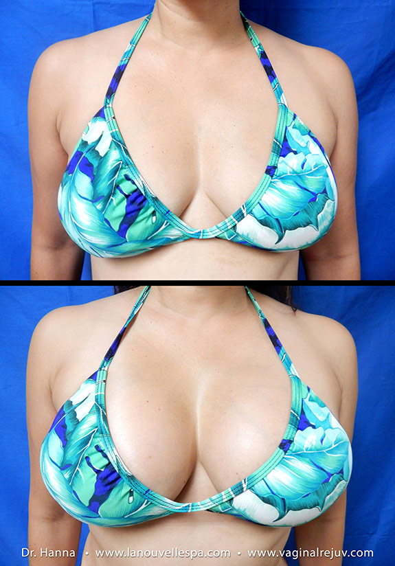 breast augmentation with silicone implants by doctor antoine hanna ventura, oxnard, los angeles