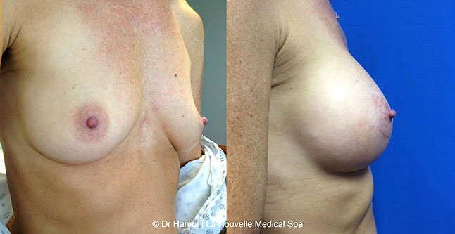 breast augmentation with silicone implants before after photos by dr. Hanna, La Nouvelle Medical Spa, Oxnard, Ventura county  