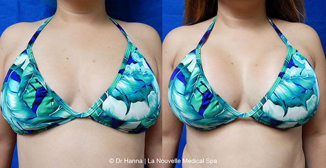 breast augmentation with silicone implants before after photos by dr. Hanna, La Nouvelle Medical Spa, Oxnard, Ventura county  