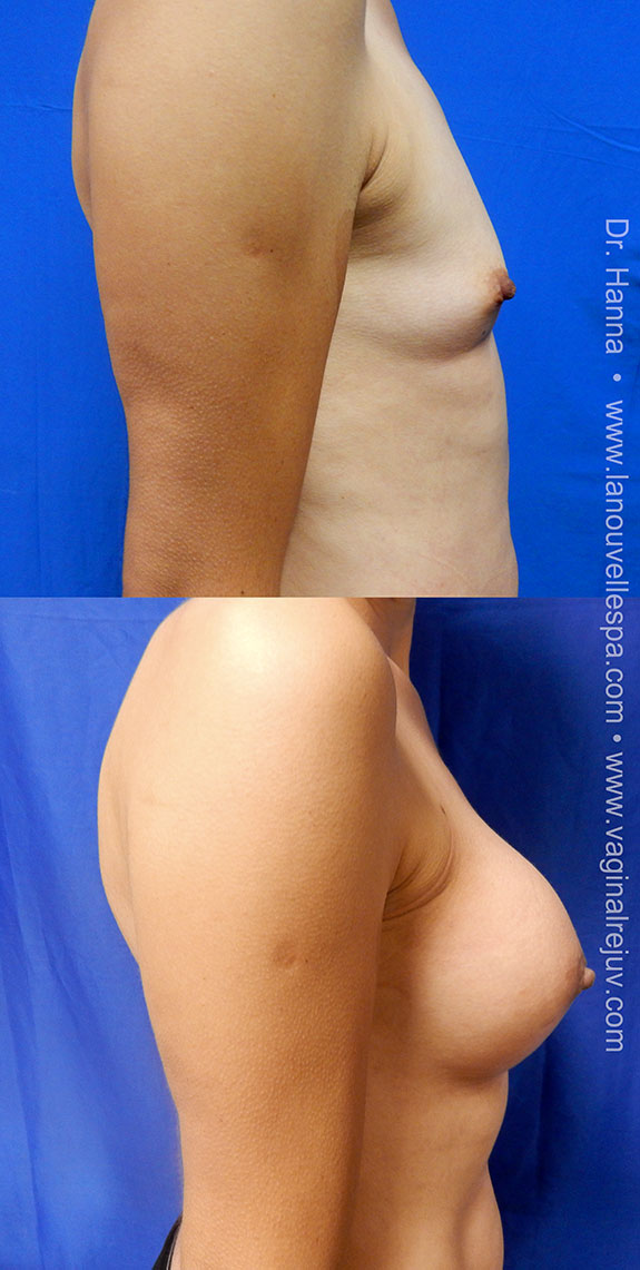 breast enhancement with silicone implants dr hanna la nouvelle oxnard ventura county los angeles 