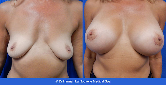 beast lift and breast augmentation with silicone implants before after photos by dr. Hanna, La Nouvelle Medical Spa, Oxnard, Ventura county  