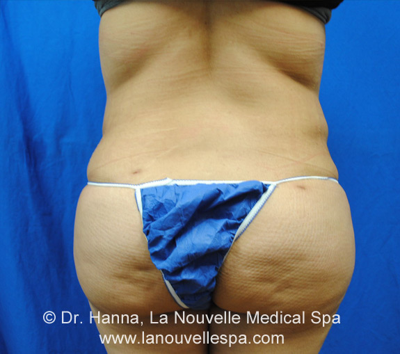 Liposuction Before and After by Dr Hanna, La Nouvelle| Oxnard, Ventura