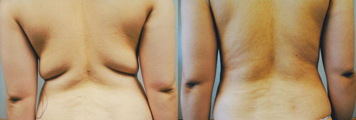 liposuction before after by dr hanna la nouvelle medical spa