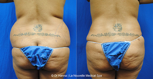 vaser liposuction smartlipo before after photos, Dr. Hanna La Nouvelle Medical Spa, Oxnard, Ventura county female back  