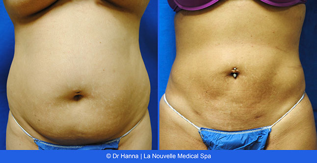 vaser liposuction smartlipo before after photos, Dr. Hanna La Nouvelle Medical Spa, Oxnard, Ventura county  
