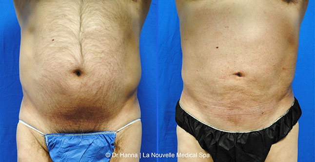 vaser liposuction smartlipo before after photos, Dr. Hanna La Nouvelle Medical Spa, Oxnard, Ventura county male abdomen 