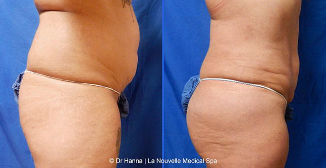 vaser liposuction smartlipo before after photos, Dr. Hanna La Nouvelle Medical Spa, Oxnard, Ventura county  