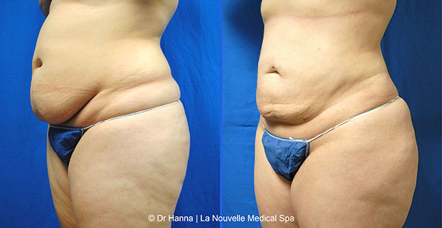 vaser liposuction smartlipo before after photos, Dr. Hanna La Nouvelle Medical Spa, Oxnard, Ventura county  femal adbomen side