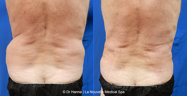 vaser liposuction smartlipo before after photos, Dr. Hanna La Nouvelle Medical Spa, Oxnard, Ventura county male back 