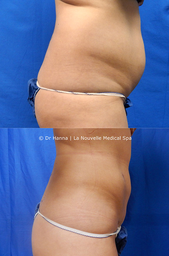 liposuction on back by dr hanna la nouvelle spa oxnard