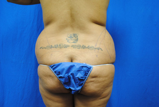 liposuction-ventura-county-female-back-before-by-dr-hanna-la-nouvelle-medical-spa