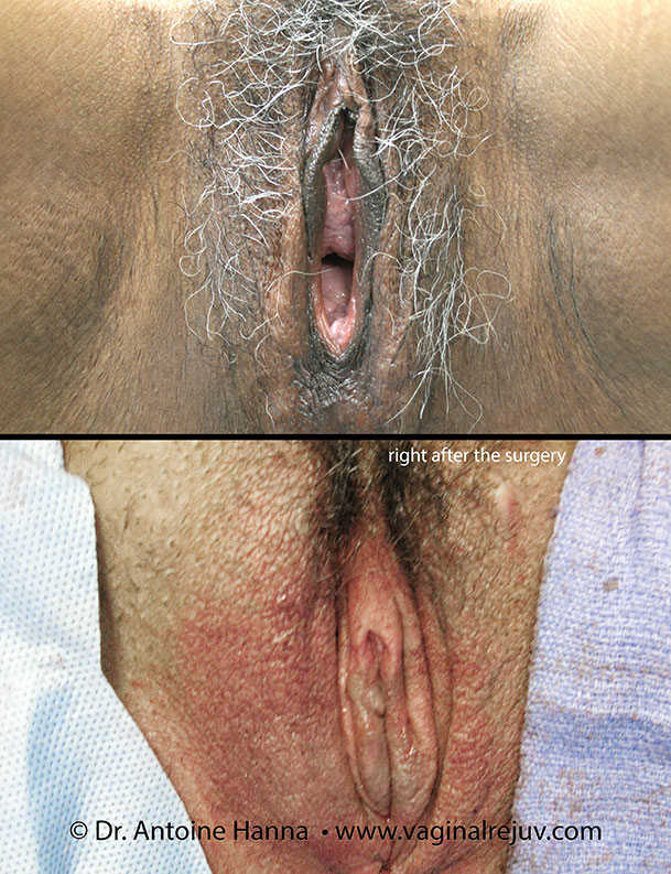 vaginoplasty vaginal tightening  by dr. Hanna, La Nouvelle Medical Center, Oxnard, Ventura county