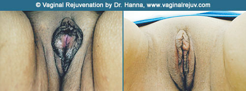 vaginal rejuvenation before and after dr hanna ventura
