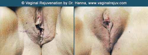 vaginal rejuvenation before and after dr hanna ventura