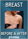 breast augmentation before after photos dr hanna la nouvelle ventura