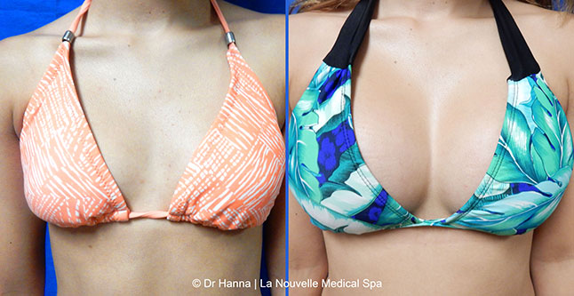 breast augmentation with silicone implants before after photos by dr. Hanna, La Nouvelle Medical Spa, Oxnard, Ventura county  