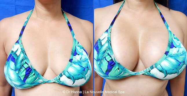 breast augmentation with silicone implants before after photos by dr. Hanna, La Nouvelle Medical Spa, Oxnard, Ventura county  