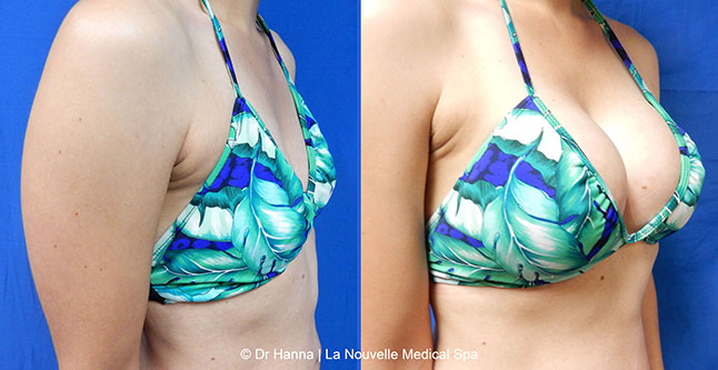 breast augmentation with silicone implants before after photos by dr. Hanna, La Nouvelle Medical Spa, Oxnard, Ventura county  