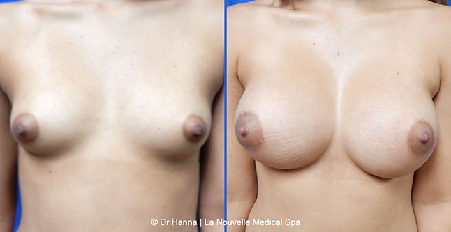 breast augmentation with silicone implants before after photos by dr. Hanna, La Nouvelle Medical Spa, Oxnard, Ventura county  