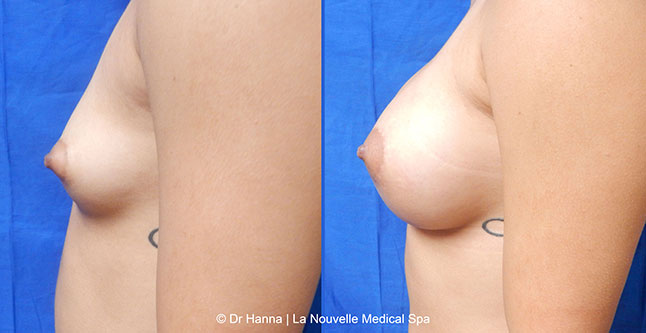 breast augmentation with silicone implants before after photos by dr. Hanna, La Nouvelle Medical Spa, Oxnard, Ventura county  