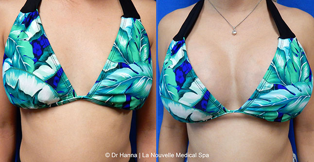 breast augmentation with silicone implants before after photos by dr. Hanna, La Nouvelle Medical Spa, Oxnard, Ventura county