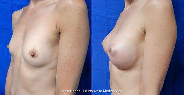 breast augmentation with silicone implants before after photos by dr. Hanna, La Nouvelle Medical Spa, Oxnard, Ventura county  