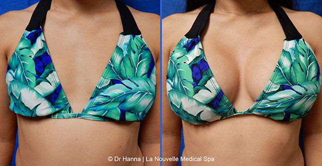 breast augmentation with silicone implants before after photos by dr. Hanna, La Nouvelle Medical Spa, Oxnard, Ventura county  