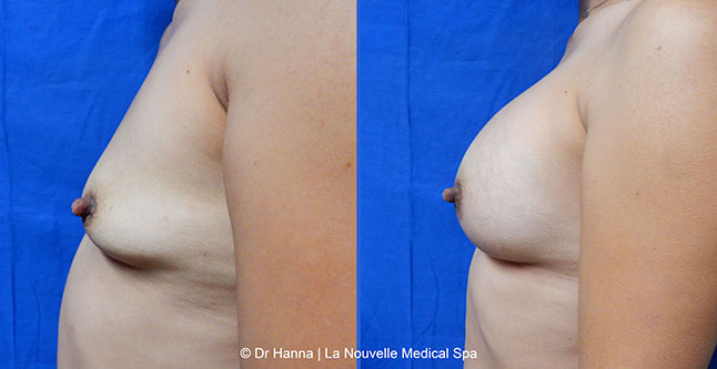 breast augmentation with silicone implants before after photos by dr. Hanna, La Nouvelle Medical Spa, Oxnard, Ventura county  