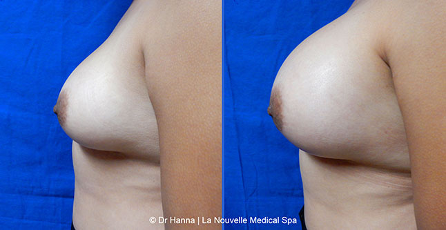 breast augmentation with silicone implants before after photos by dr. Hanna, La Nouvelle Medical Spa, Oxnard, Ventura county