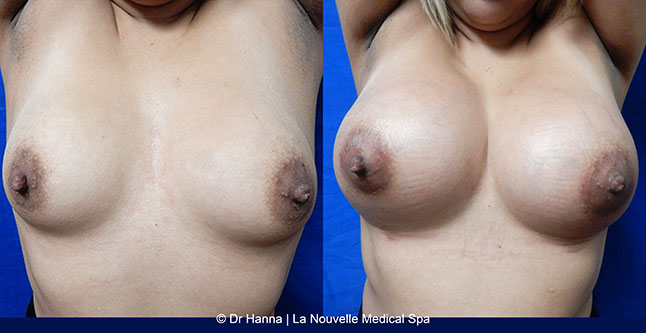breast augmentation with silicone implants before after photos by dr. Hanna, La Nouvelle Medical Spa, Oxnard, Ventura county