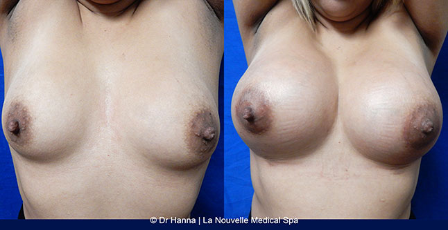 breast augmentation with silicone implants before after photos by dr. Hanna, La Nouvelle Medical Spa, Oxnard, Ventura county  