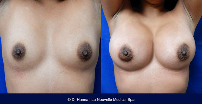 breast augmentation with silicone implants before after photos by dr. Hanna, La Nouvelle Medical Spa, Oxnard, Ventura county  