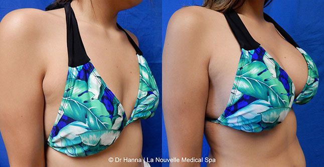 breast augmentation with silicone implants before after photos by dr. Hanna, La Nouvelle Medical Spa, Oxnard, Ventura county