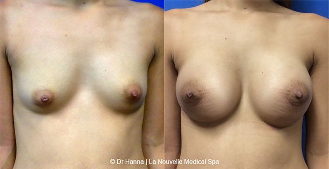 breast augmentation with silicone implants before after photos by dr. Hanna, La Nouvelle Medical Spa, Oxnard, Ventura county  