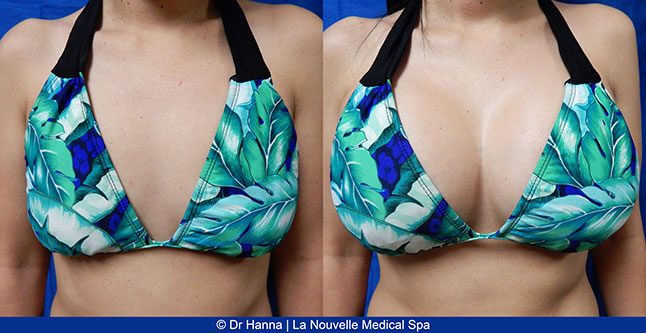 breast augmentation with silicone implants before after photos by dr. Hanna, La Nouvelle Medical Spa, Oxnard, Ventura county  