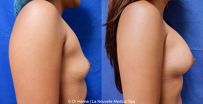 breast augmentation with silicone implants before after photos by dr. Hanna, La Nouvelle Medical Spa, Oxnard, Ventura county  