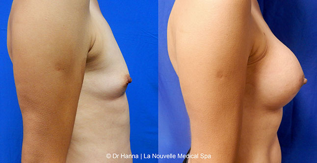 breast augmentation with silicone implants before after photos by dr. Hanna, La Nouvelle Medical Spa, Oxnard, Ventura county  