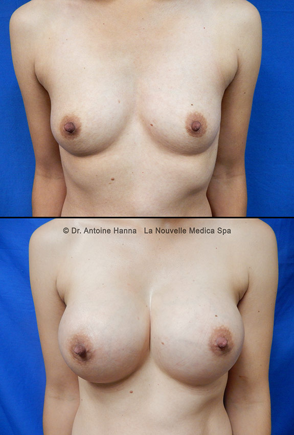 breast augmentation with silicone implants before after by dr antoine hanna ventura