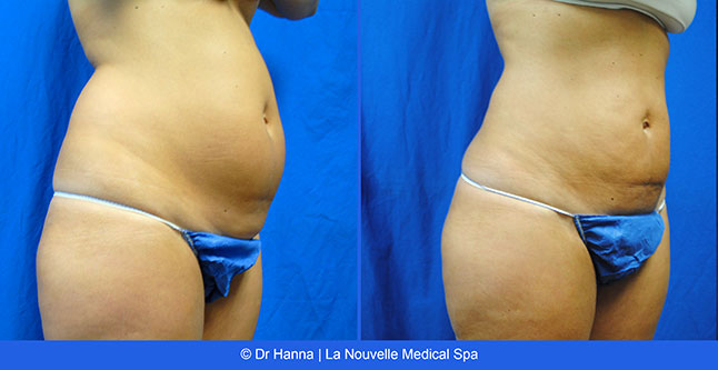 vaser liposuction smartlipo before after photos, Dr. Hanna La Nouvelle Medical Spa, Oxnard, Ventura county  