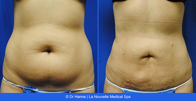 vaser liposuction smartlipo before after photos, Dr. Hanna La Nouvelle Medical Spa, Oxnard, Ventura county  