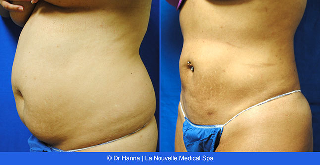 vaser liposuction smartlipo before after photos, Dr. Hanna La Nouvelle Medical Spa, Oxnard, Ventura county  