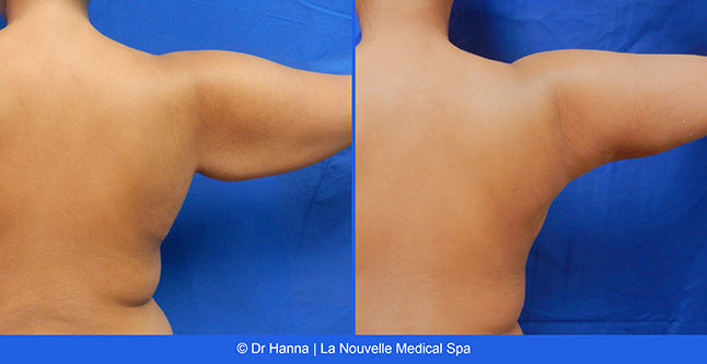 vaser liposuction smartlipo before after photos, Dr. Hanna La Nouvelle Medical Spa, Oxnard, Ventura county  