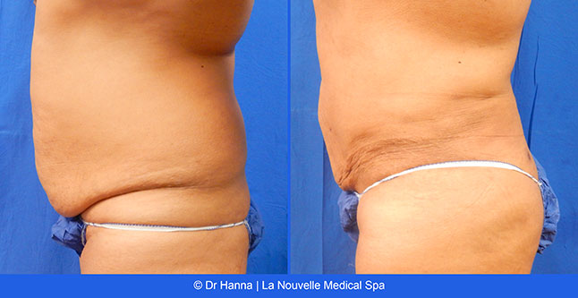 vaser liposuction smartlipo before after photos, Dr. Hanna La Nouvelle Medical Spa, Oxnard, Ventura county  