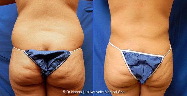 vaser liposuction smartlipo before after photos, Dr. Hanna La Nouvelle Medical Spa, Oxnard, Ventura county  