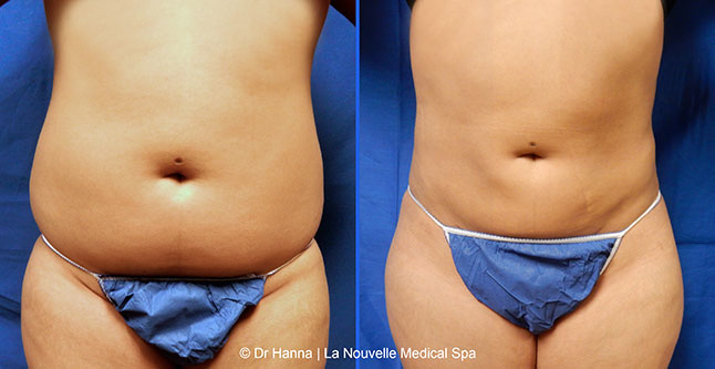 vaser liposuction smartlipo before after photos, Dr. Hanna La Nouvelle Medical Spa, Oxnard, Ventura county  