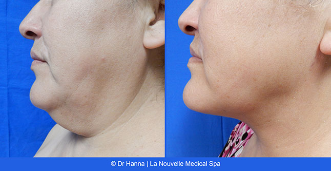 vaser liposuction smartlipo before after photos, Dr. Hanna La Nouvelle Medical Spa, Oxnard, Ventura county  