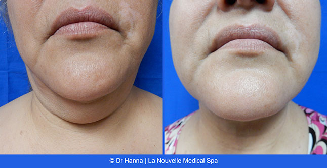 vaser liposuction smartlipo before after photos, Dr. Hanna La Nouvelle Medical Spa, Oxnard, Ventura county  