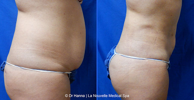 vaser liposuction smartlipo before after photos, Dr. Hanna La Nouvelle Medical Spa, Oxnard, Ventura county  