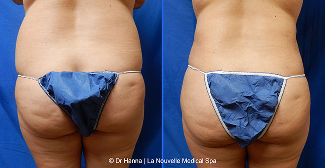 vaser liposuction smartlipo before after photos, Dr. Hanna La Nouvelle Medical Spa, Oxnard, Ventura county  